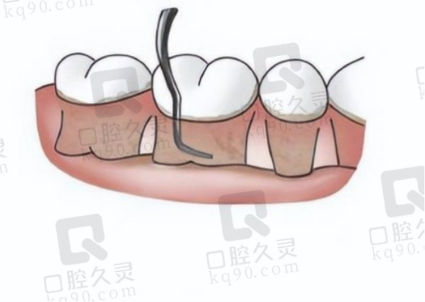 龈下刮治能治好牙周炎吗