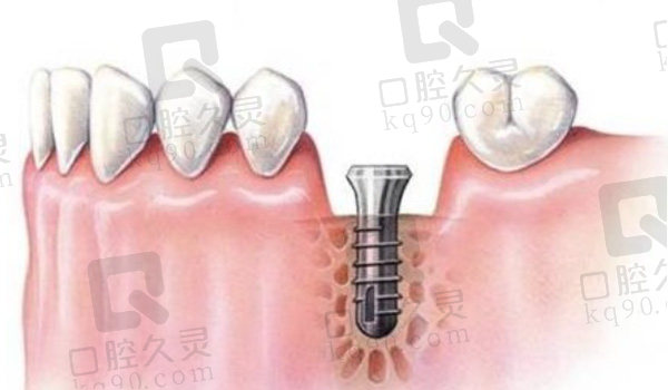 种植牙种植位置