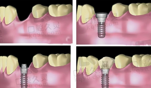 种植牙步骤