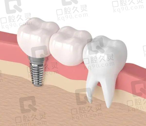 正规医院单颗种植牙收费标准：3000-8000元起