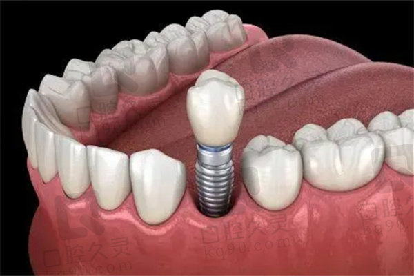 种植牙一千多和几千的区别是什么？