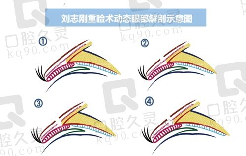 刘志刚重睑术示意图