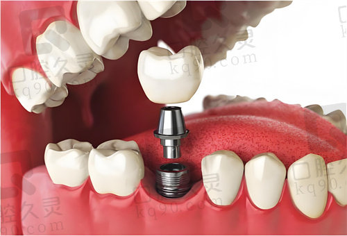 赣州方华口腔医院韩国仕诺康种植牙价格表