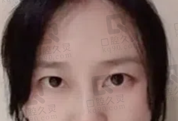 近视手术后