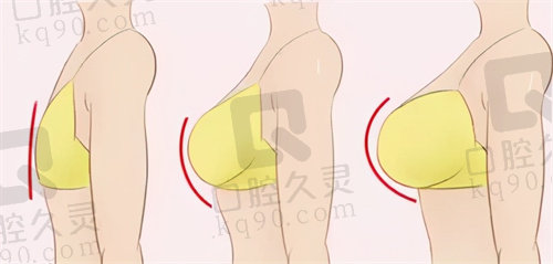 北京煤医王驰医生奈菲尔傲秘隆胸价格