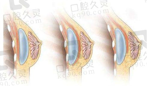 北京煤医王驰医生奈菲尔傲秘隆胸优势