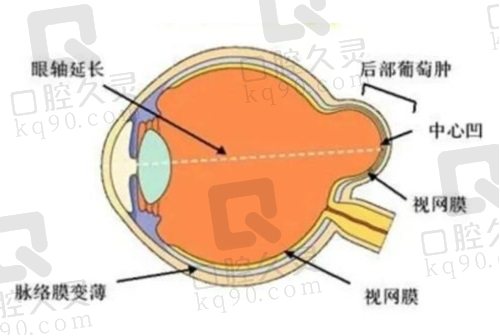 王乐今医生微创后巩膜加固术