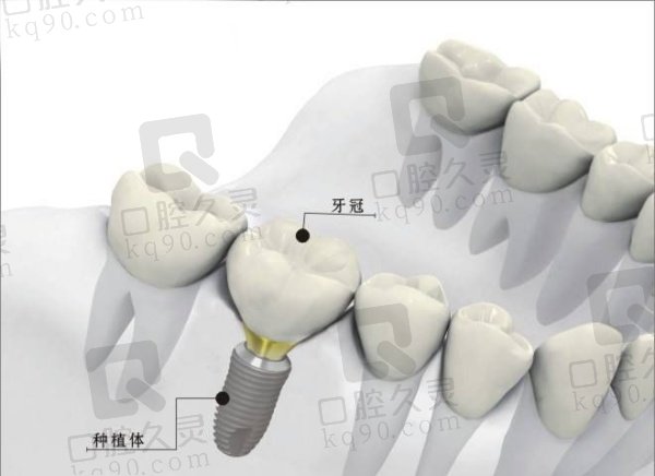 烟台欢乐口腔种植牙怎么样