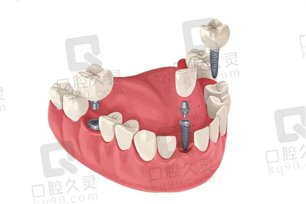 数字化种植牙有什么优点？