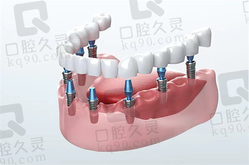 韩国仕诺康烤瓷牙冠术后护理