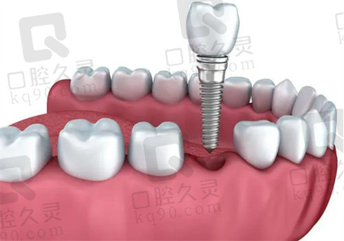 长沙美呀口腔医院种植牙怎么样