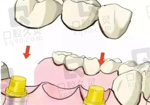 长沙美呀口腔医院种植牙多少钱