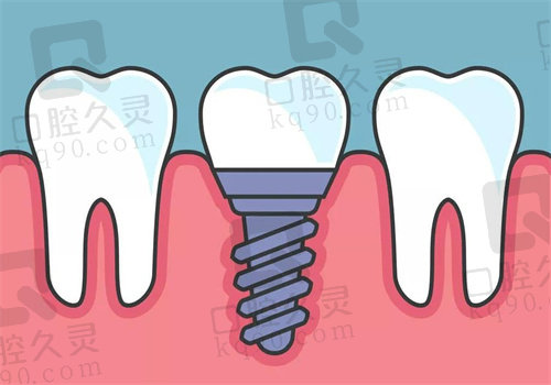 长沙美呀口腔医院种植牙