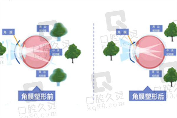 麦迪格角膜塑形镜怎么样