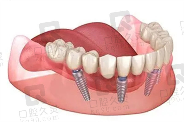 株洲乐莎莎口腔医院种植牙价格