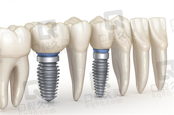 株洲乐莎莎口腔医院种植牙价格