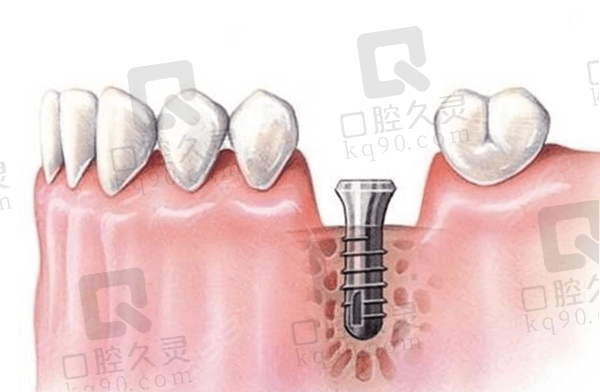 日照牙科医院种植牙价格表