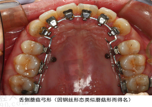 如何选择适合自己的龅牙矫正方法?