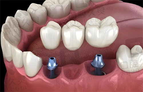 深圳诺德口腔医院韩国奥齿泰种植牙价格