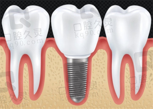 深圳诺德口腔医院韩国奥齿泰种植牙项目优势