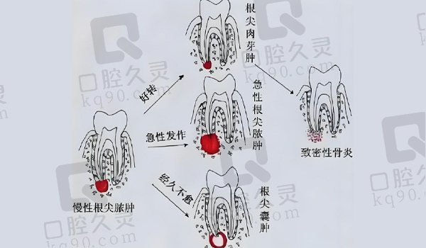 根尖周炎可能形成的牙齿疾病