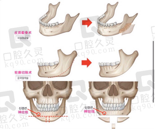 黄大勇下颌角手术价格贵吗？