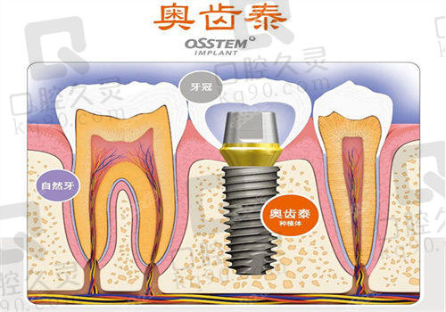 种植牙哪个国 家材料好性价比高