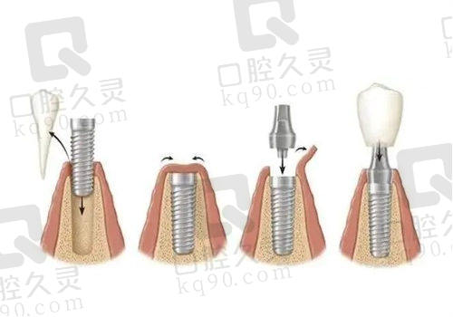 种植牙材料的主要类型