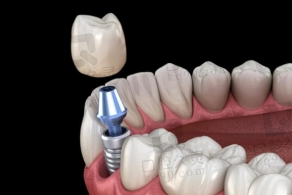 烤瓷牙和种植牙的价格是多少
