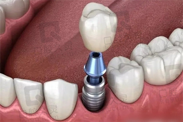 烤瓷牙和种植牙的价格是多少