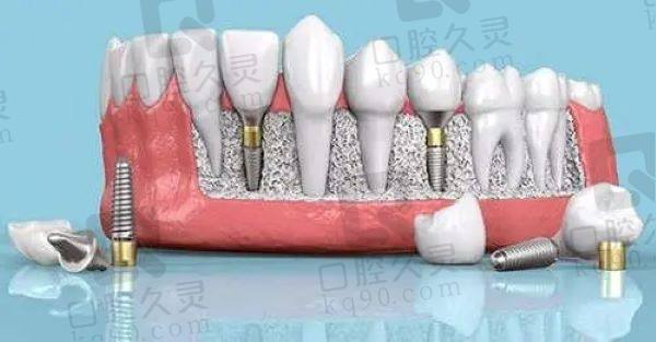 郑州牙科种植牙价格表