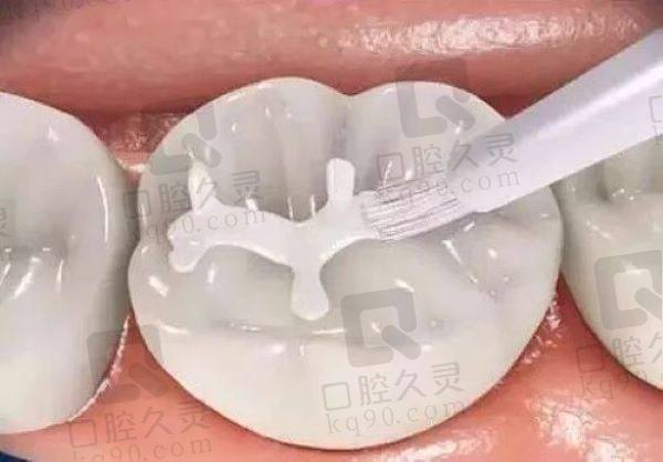 郑州牙科补牙价格表 郑州牙科补牙价格表
