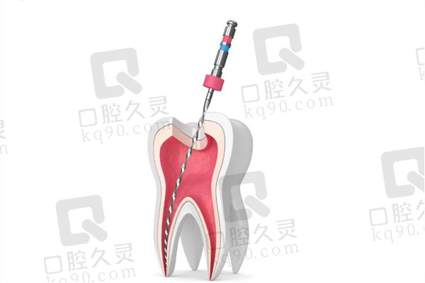 根管治疗费用大概是多少