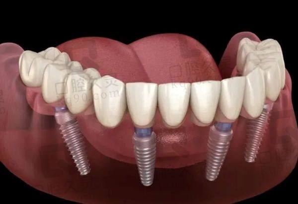 杭州牙科医院种植牙价格表