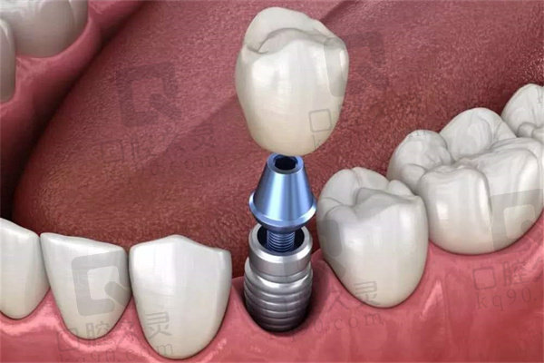 种植牙牙冠金属跟全瓷的区别