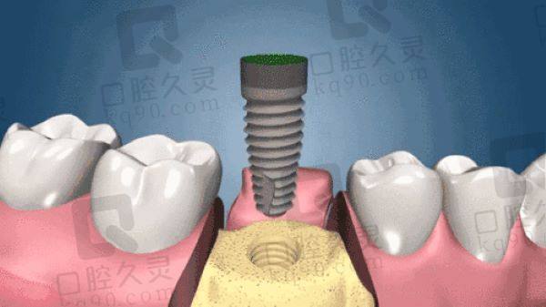 西安登腾种植牙价格大概多少钱一颗