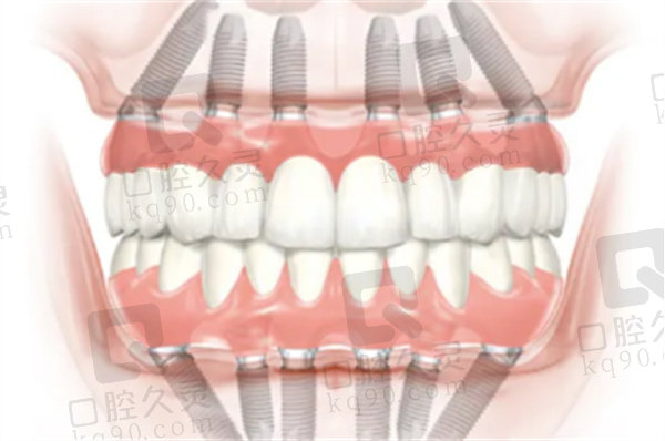 广州曙光美云口腔医院全口种牙