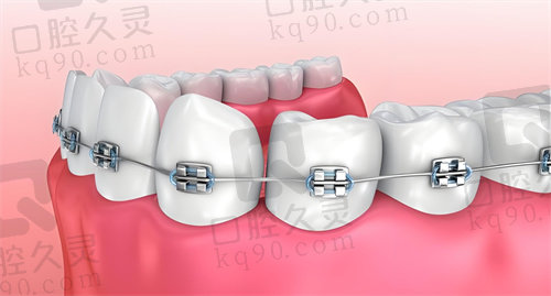 海口诺贝尔口腔医院传统金属托槽矫正流程
