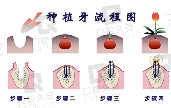 4000元种植牙有没有潜在套路？