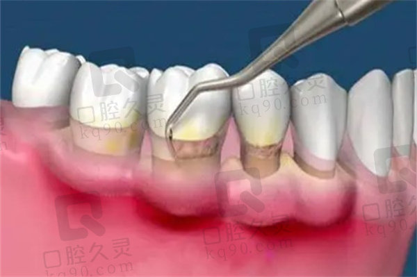 宜昌中汉口腔医院做龈下刮治过程图