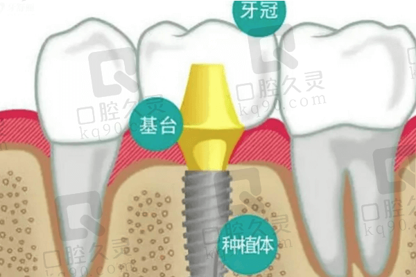 德国进口种植牙多少钱一颗？