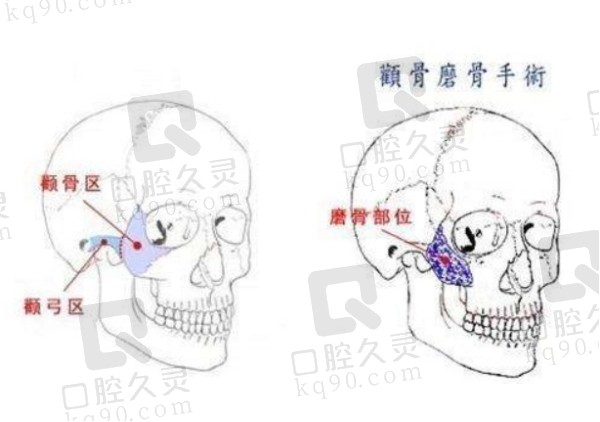 南京吴国平下颌角手术怎么样