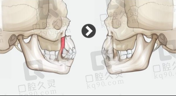 南京吴国平正颌、偏颌手术怎么样
