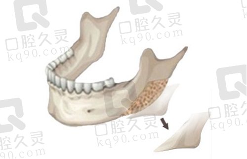 赵绛波医生颌面下颌角整形