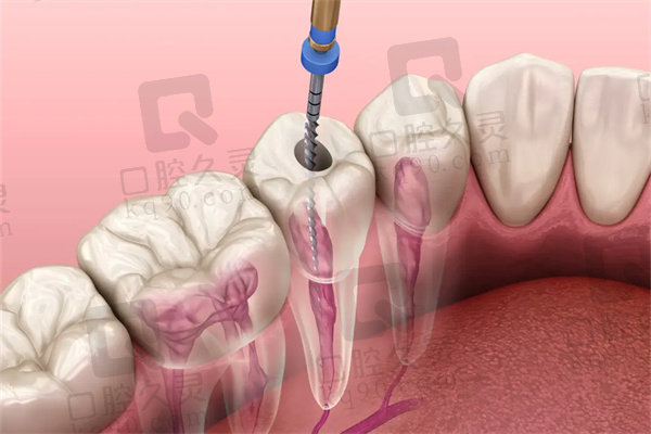 郑州德韩口腔医院根管治疗怎么样