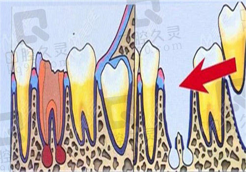 人工种植牙的价格是多少?