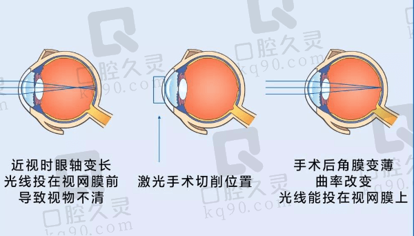 成都悦瞳眼科医院全飞秒4.0近视矫正手术价格18800元起