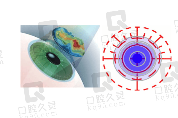 成都悦瞳眼科医院全飞秒4.0及时手术有哪些优势特色呢？