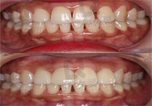 牙齿矫正门牙一高一低怎么办