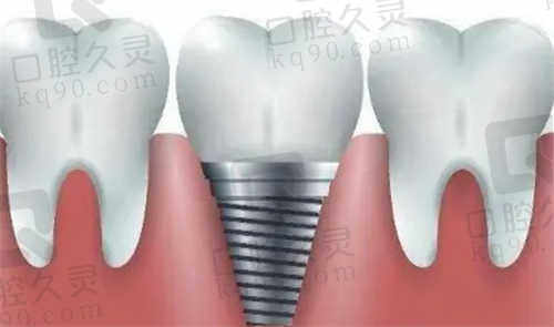 长沙牙祖口腔种植牙口碑介绍